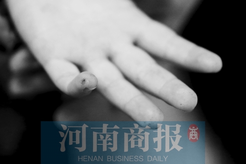 1岁“小糖人”手脚布满针眼 家长希望把儿童糖尿病纳入医保 