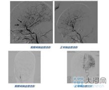 河南一女子竟得“烟雾病” 一起来科普一下吧