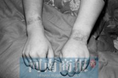 登封20岁男孩因患病 被亲生父母用铁链锁住447天