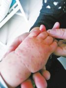 漯河一岁半男童输液后浑身起疙瘩 医生用了禁用药