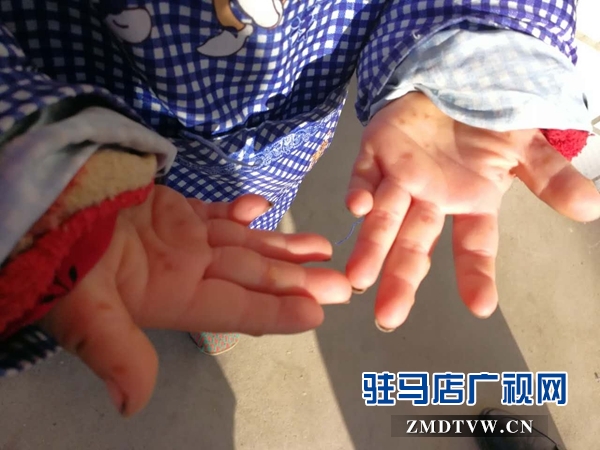 老太太让戴文生看看其外孙女的患病的一双手.jpg