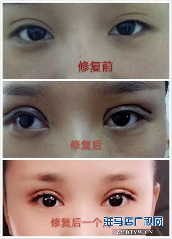 术前术后对比照1