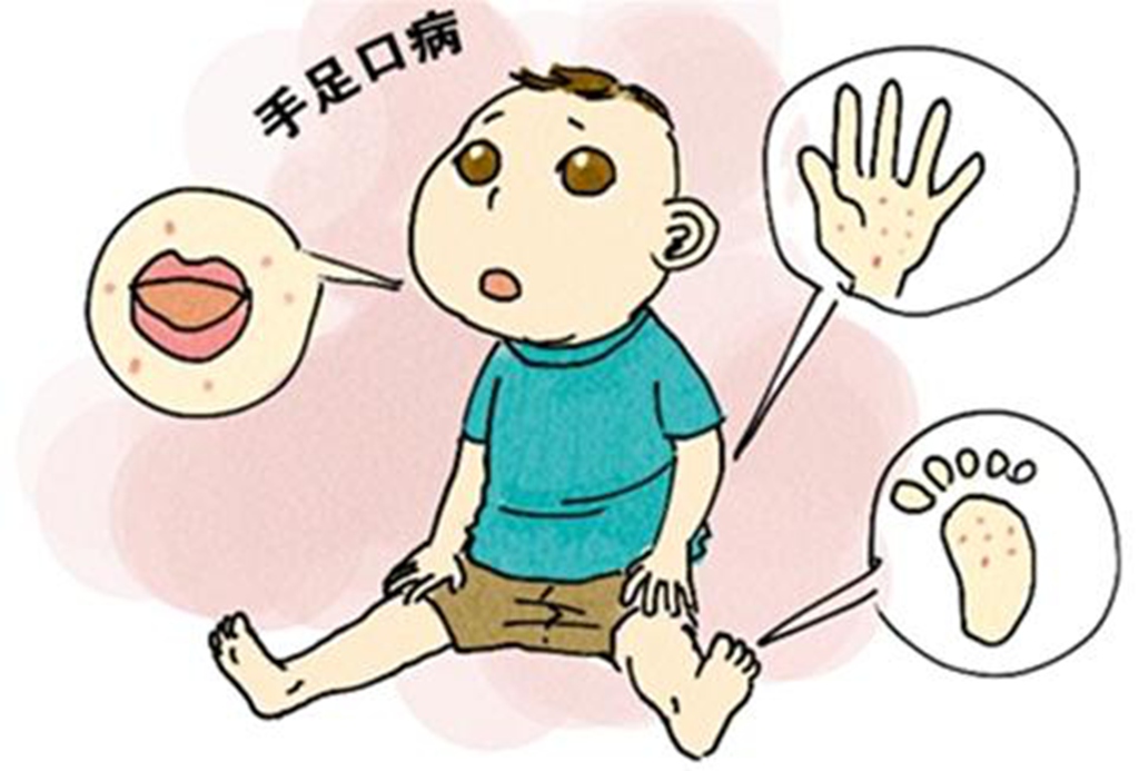 春季是手足口病高发期  专家提醒要注意防范