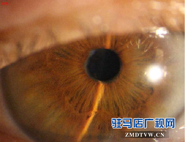 脱贫后，患眼疾20多年重见光明