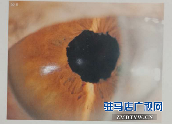 脱贫后，患眼疾20多年重见光明