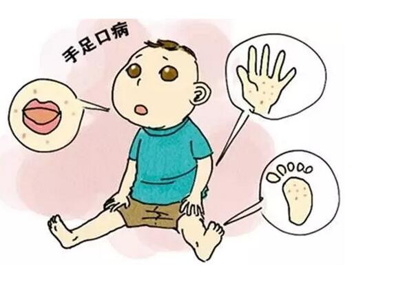 手足口病进入高发季 提前预防 避免反复感染