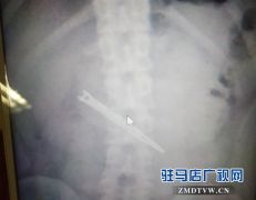 这一幕看呆医生！男子胃里竟然有把剪刀！