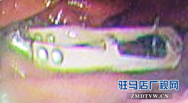 这一幕看呆医生！男子胃里竟然有把剪刀！