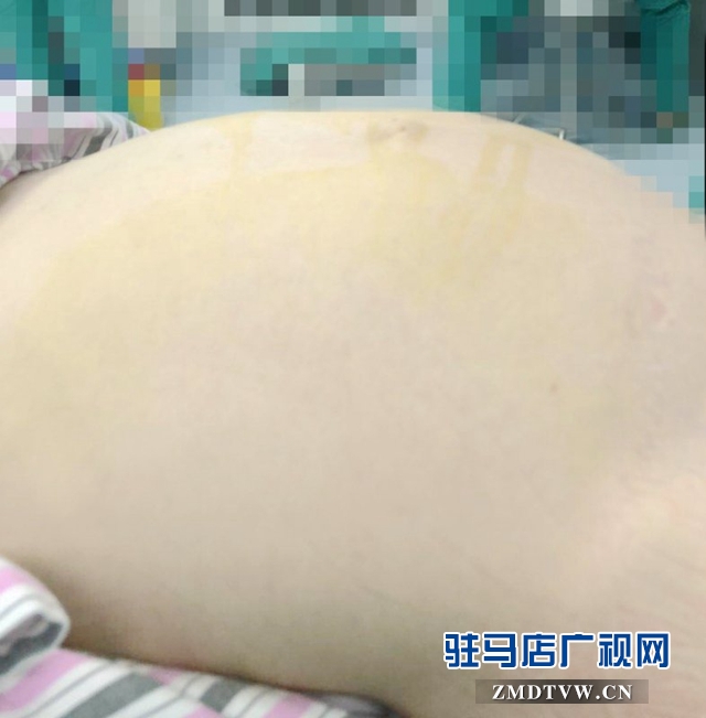 以为“三胎”之喜 不料肿瘤来袭