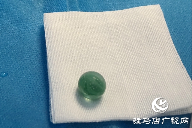 女童下体误塞异物    医生手术安全取出