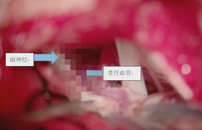 市中心医院在神经电生理监测下微创手术治愈“面肌痉挛”