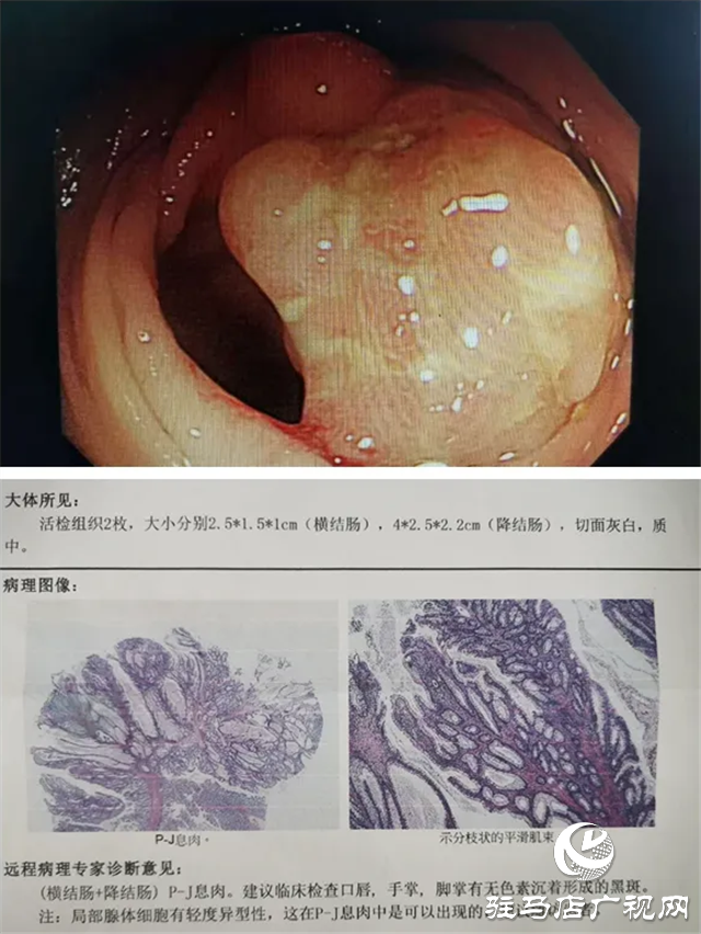 “黑痣”长在嘴上，息肉生在肠内！市中心医院专家为一罕见病患者内镜下切除30多处肠道肿物