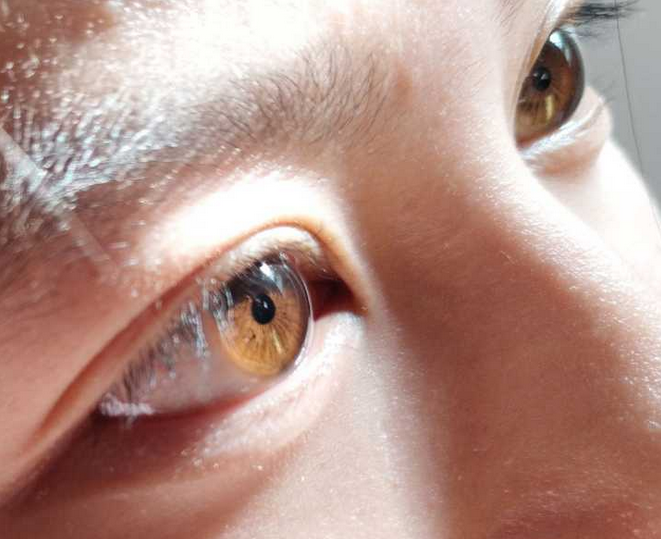 眼皮肿，一运动眼就疼怎么办？关于眼睛这些事情要了解