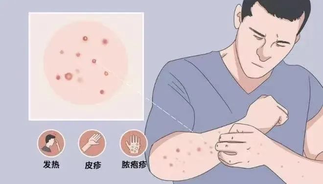 “猴痘”是什么？有哪些传播途径？如何科学应对猴痘病毒？——权威专家回应