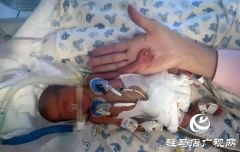 30多个日夜的生命守护使双胞胎“手掌宝宝”转危为安