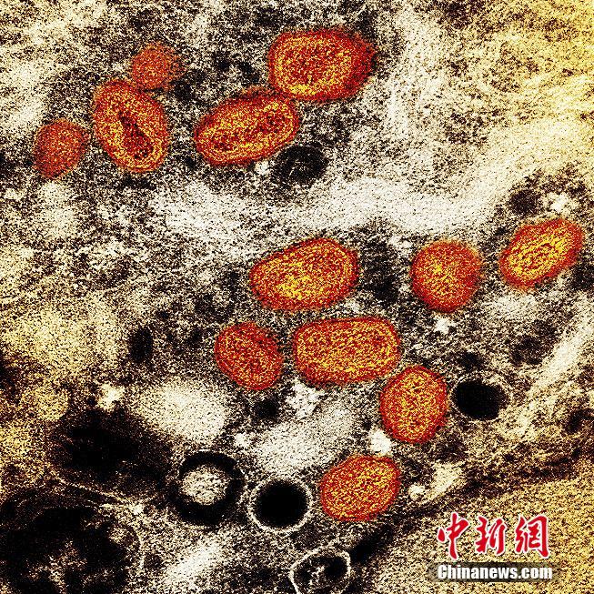 资料图：当地时间2022年7月26日，美国马里兰州，在实验室培养的感染细胞(棕色)中发现的猴痘颗粒(橙色)的彩色透射电子显微图。图片来源：视觉中国