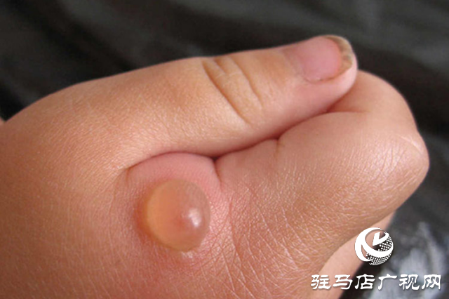 夏季被蚊虫“叮”上怎么办?皮肤科医生教你巧防治
