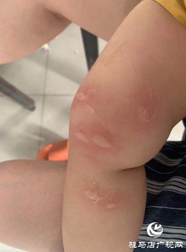 夏季被蚊虫“叮”上怎么办?皮肤科医生教你巧防治