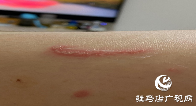 夏季被蚊虫“叮”上怎么办?皮肤科医生教你巧防治