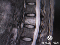 打个喷嚏还能骨折？百岁老人伤不起