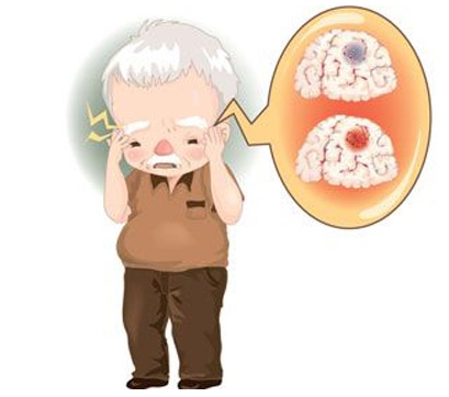 中暑or脑卒中?夏季要当心，莫把它们弄混了