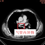 老人咳喘20载 市中心医院揪出“假牙”真凶