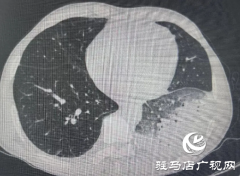 男子肺炎久治不愈  竟是家中“宠物”惹的祸