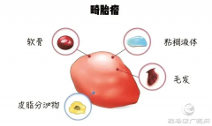 百闻不如一见！14岁少女“身怀怪胎”?