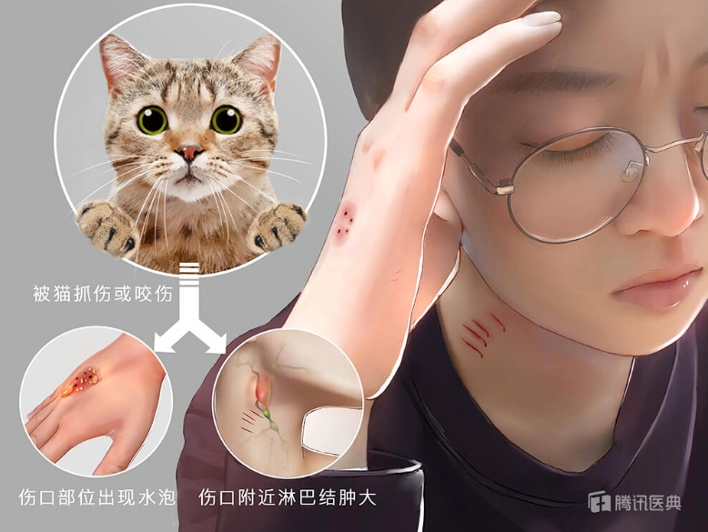 20岁小伙反复高烧40℃、几近失明！只因接触了这种动物......